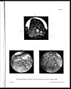 Thumbnail of file (69) Plate III - Photo-micrographs of sections of small intestine in case of "peshawar fever"