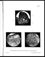 Plate IIIPhoto-micrographs of sections of small intestine in case of "peshawar fever"